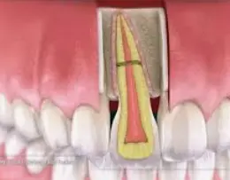 ﻿Tooth root fractures﻿