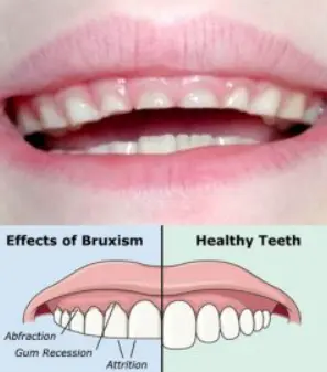 ﻿Bruxism﻿