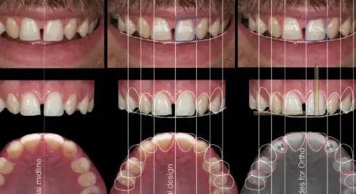 [FURN_1118] ﻿Congenitally missing teeth﻿